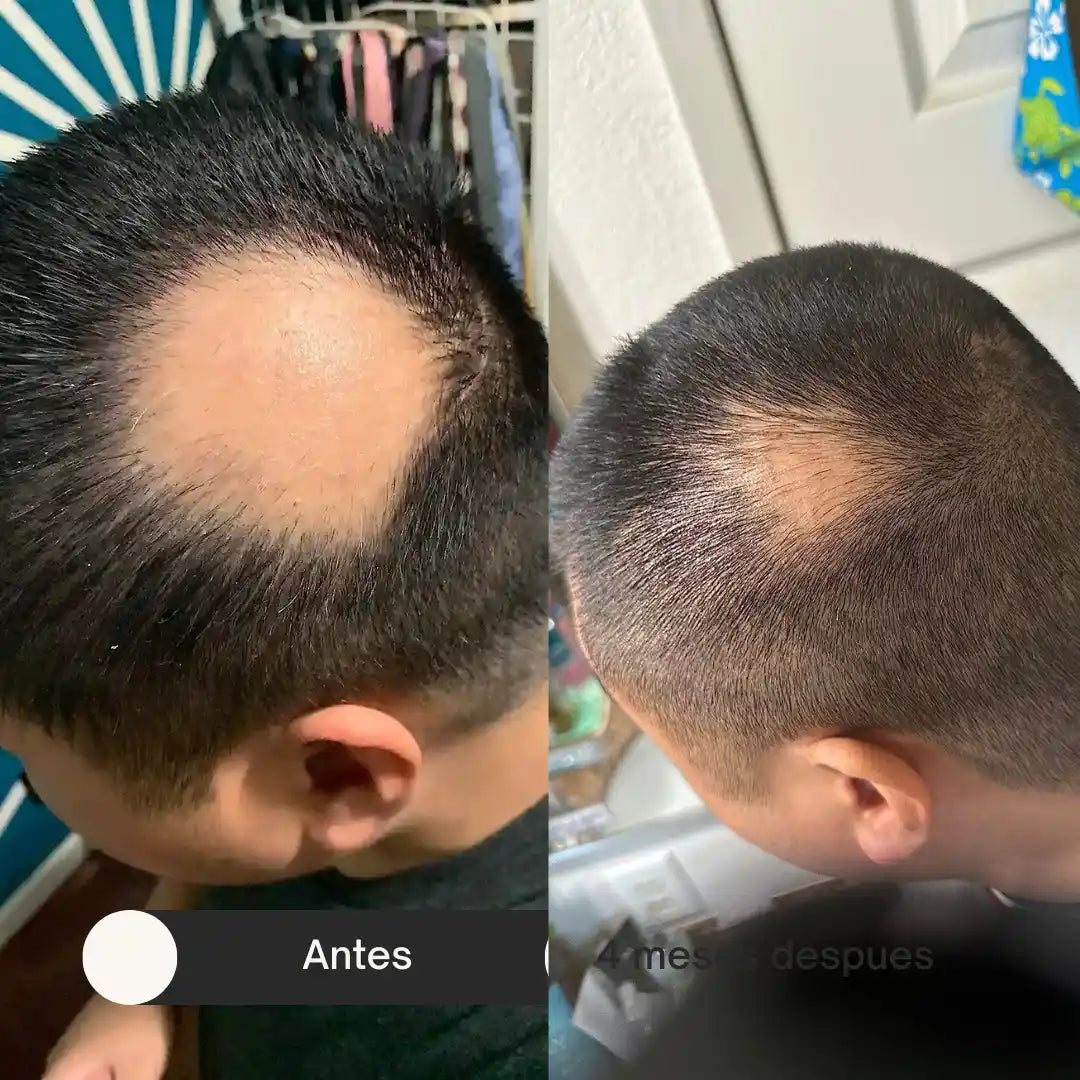 HairGlow Pro™  | La Solución Definitiva para la Caída del Cabello