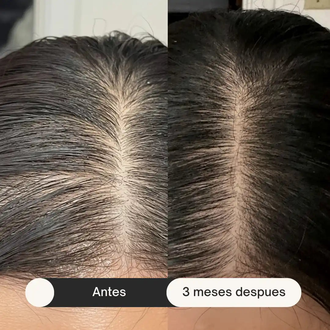 HairGlow Pro™  | La Solución Definitiva para la Caída del Cabello